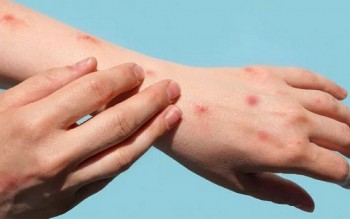 nguoi mac benh dau mua khi co the khong co trieu chung