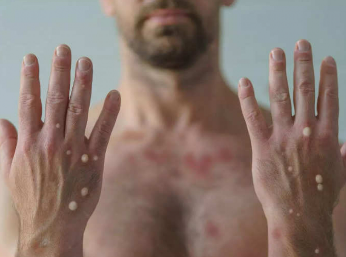 chuyen gia my so ca mac dau mua khi dang giam dan