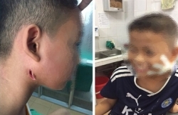 Phát hiện 3 trẻ nhiễm "vi khuẩn ăn thịt người" ở Nghệ An