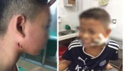 3 bệnh nhi mắc bệnh Whitmore ở Nghệ An: Sức khỏe chuyển biến tốt, 1 người đã được xuất viện