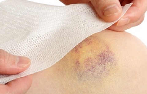 Xuất huyết dưới da: Bệnh thường gặp nhưng cảnh báo nhiều bệnh lý nguy hiểm