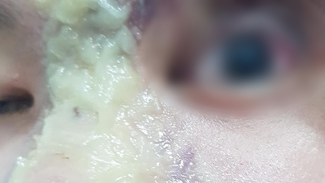 Thiếu nữ 15 tuổi bị mù mắt vĩnh viễn sau tiêm filler nâng mũi giá 1,5 triệu