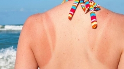 8 cach chua chay nang cho lan da sieu toc ngay tai nha