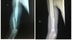 choi vat tay voi ban nam thanh nien bi gay xuong canh tay