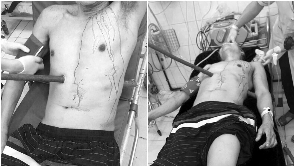 Hy hữu: Bệnh nhân bị cọc dài 1m đâm xuyên thấu người do trượt ngã từ cây