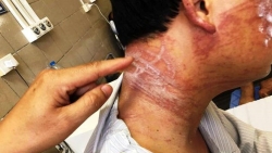 ha noi nam thanh nien bi hoai tu da vi bong sua lua