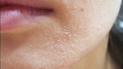 cham soc da kho mua thu dong 10 loai thuc pham giup duong da khoe dep