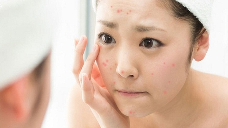 Bí kíp chăm sóc da tuổi dậy thì để trở thành “hot girl” học đường