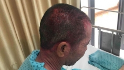 di ung thuoc nhuom toc benh nhan bi phong rop da dau co va mat