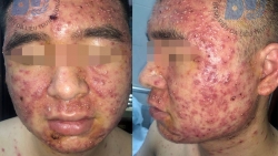 tri mun trung ca bang thuoc nam thanh nien bi mu lan khap mat
