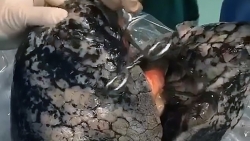 clip bo phoi den nhu than cua nguoi dan ong nghien thuoc la 30 nam