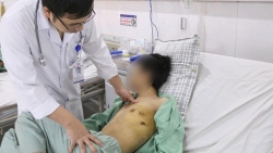 hut thuoc la 5 nam thanh nien 23 tuoi bi mau tran vao khoang phoi