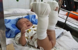 be trai 4 thang tuoi nghi bi cha danh xuat huyet nao gay chan