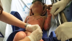 co giao dung con day phong chong chay no 3 tre mam non bi bong nang