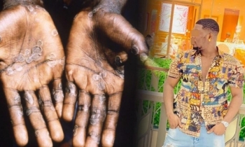 campuchia truy tim du khach mac benh dau mua khi tron tu thai lan sang