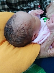 Nghệ An: Mổ đẻ bất cẩn, bé sơ sinh phải khâu 6 mũi trên đầu