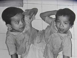 Những ca phẫu thuật tách rời cặp song sinh dính liền nhau ở Việt Nam khiến thế giới kinh ngạc
