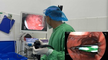 bac si bat ngo phat hien ban chai danh rang va ruot but bi trong da day benh nhan