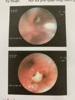 can tho lay thanh cong hat dau phong nam trong phoi cu ong suot 2 thang