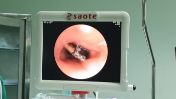 can tho noi soi phe quan lay di vat hat sapoche nam trong phe quan 27 nam