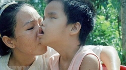 Nhật Bản hỗ trợ Việt Nam cải thiện sức khỏe trẻ sơ sinh tại vùng nhiễm chất độc da cam