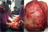 cat bo khoi u khung chiem tron o bung cung nua dai trang phai