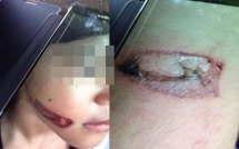 vu be gai nghi bi gi sat nung vao nguoi da co ket qua giam dinh cong an khoi to vu an