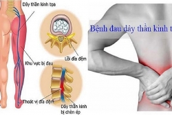 Bài tập dành cho người đau thần kinh tọa