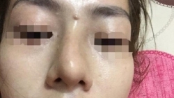 be gai 13 tuoi bi mu sau khi giau me di nang mui tra gop